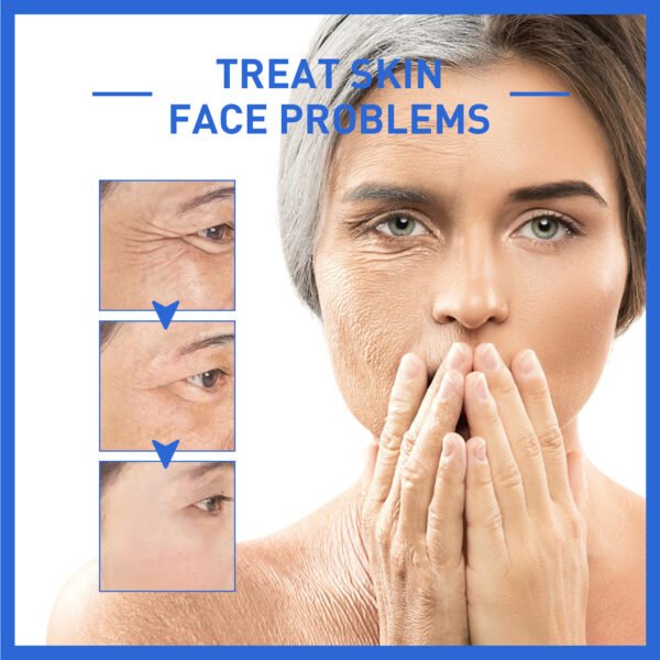 Anti-Wrinkle Firming Head Lifting Pattern French Pattern Fading Wrinkle Botox - Image 5