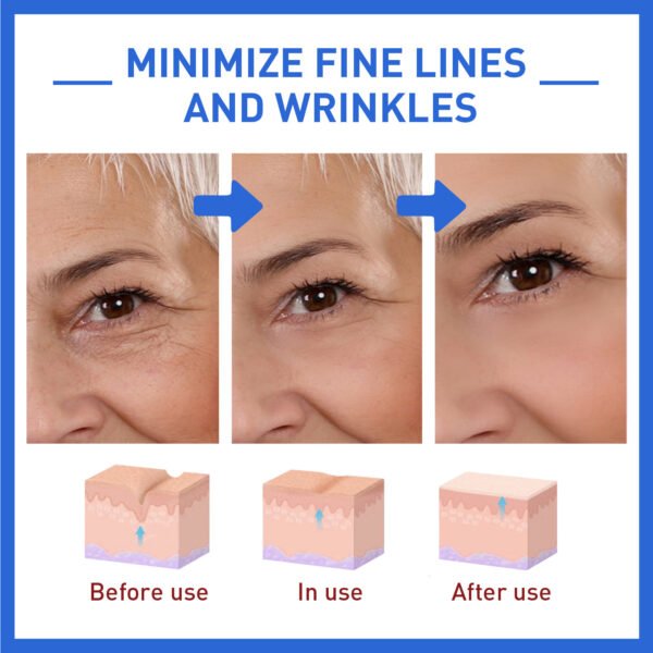 Anti-Wrinkle Firming Head Lifting Pattern French Pattern Fading Wrinkle Botox - Image 3